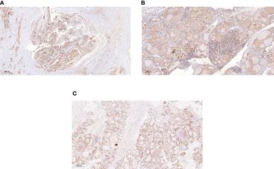 Relationship between serum NDRG3 and papillary thyroid carcinoma